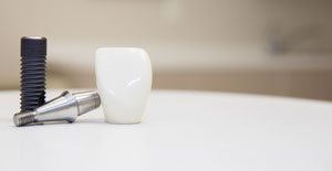 dental implants tampa fl
